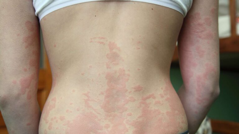 Severe Allergic Reactions