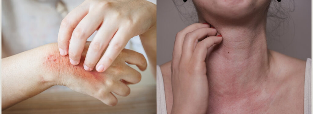 Remedies for Sun Poisoning and Allergy Reaction