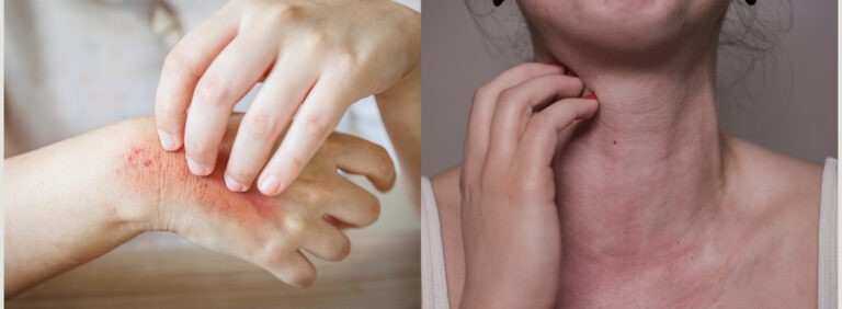 Remedies for Sun Poisoning and Allergy Reaction
