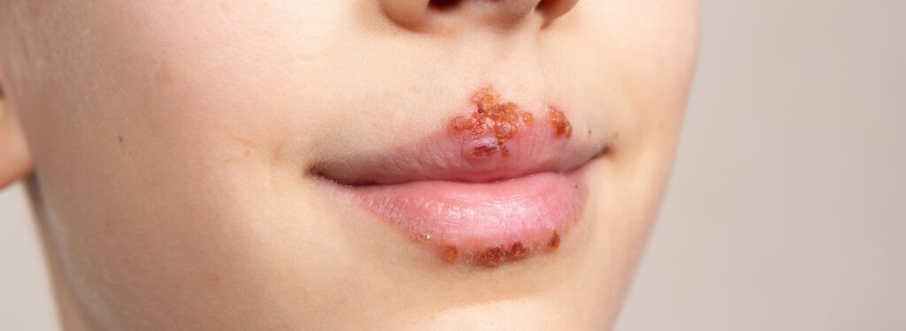 Mouth Herpes
