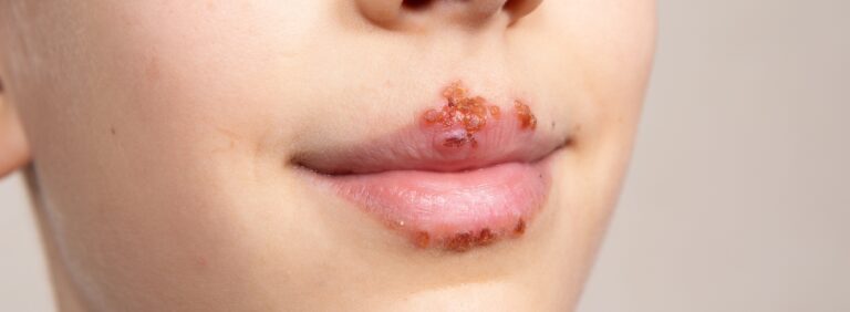 Mouth Herpes