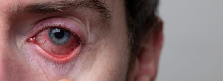 Eye Drops for Pink Eye