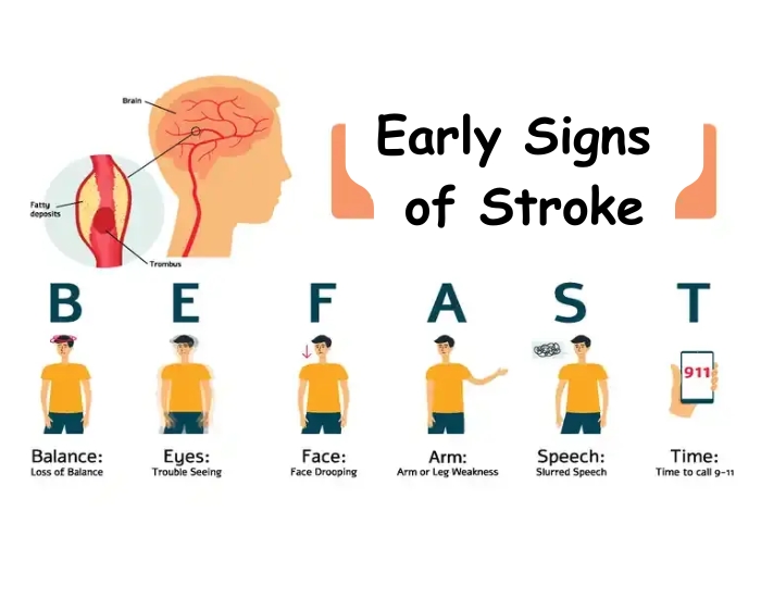Early Signs of Stroke You Should Never Ignore: When to Go to the ER in Houston