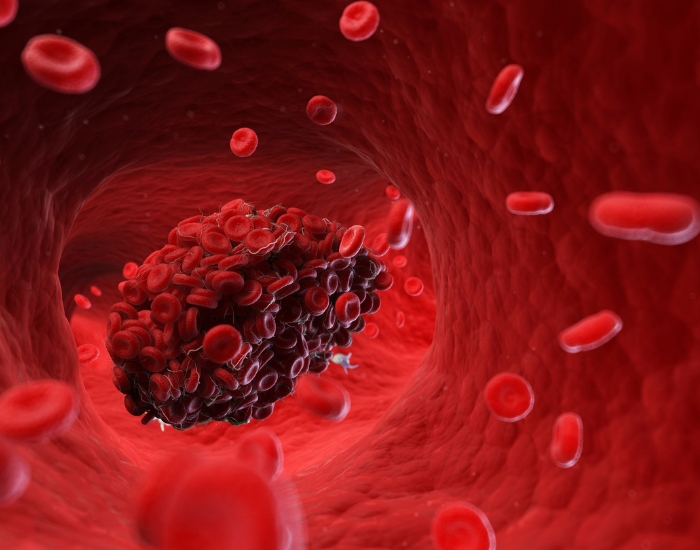 Blood Clot Symptoms in the Leg | DVT Warning Signs & ER