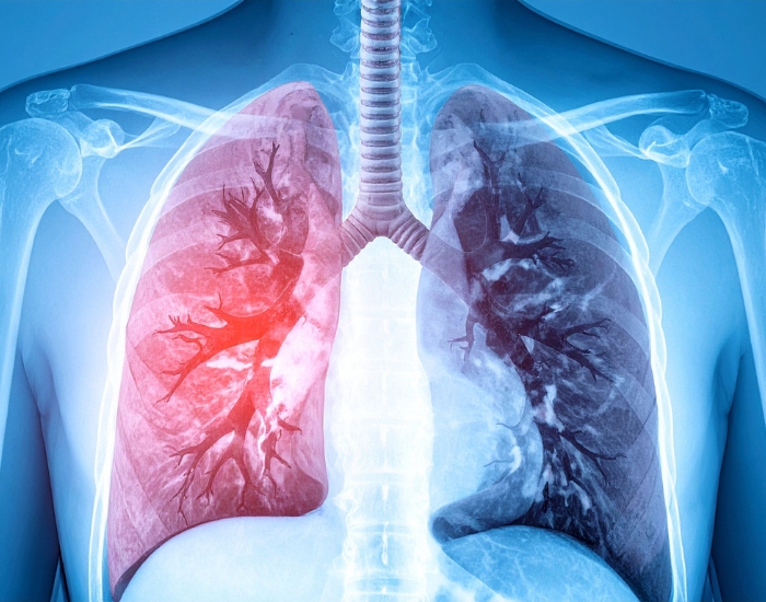 pulmonary embolism symptoms