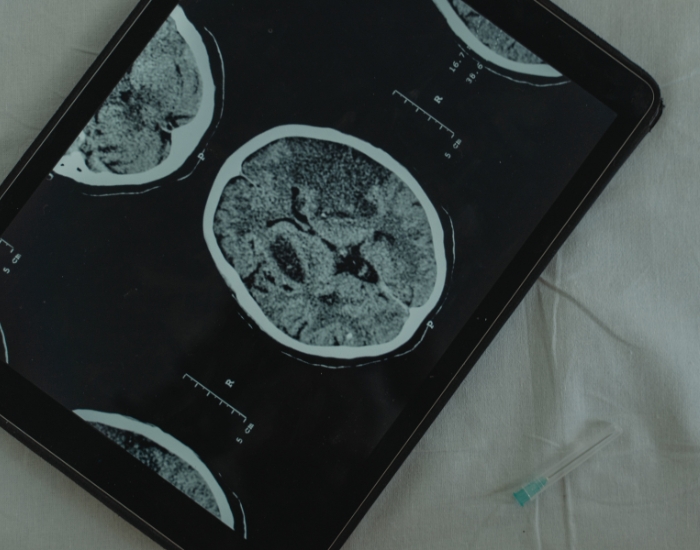 What Does a Mini Stroke Feel Like?