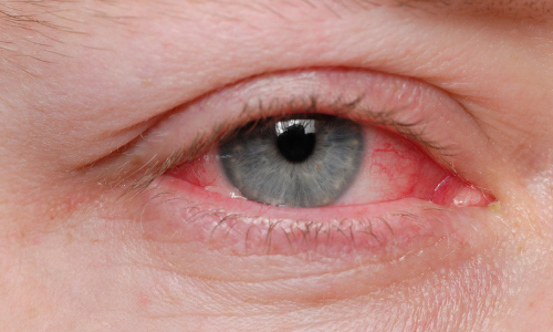 pink eye treatment Houston Pink Eye ER in Houston, TX | 24/7 Emergency Care